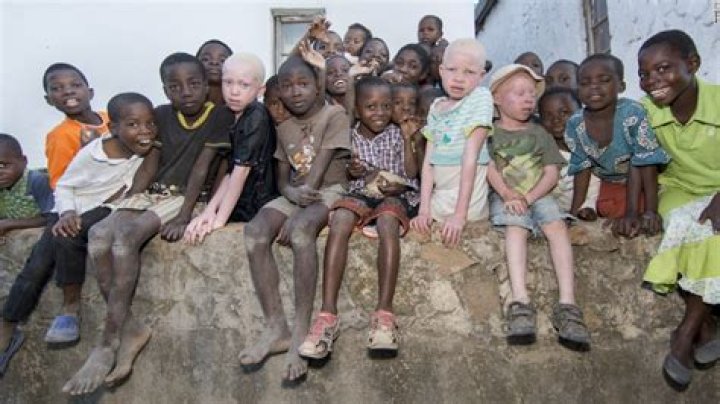 Are albinos hunted in africa?