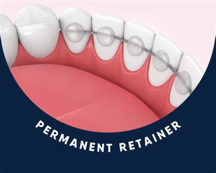 Are retainers supposed to be tight?