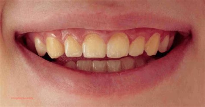 Are slightly yellow teeth normal?