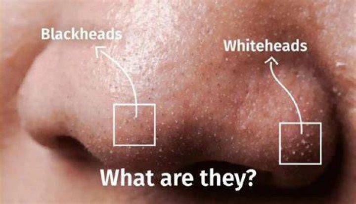 Are whiteheads and blackheads the same?