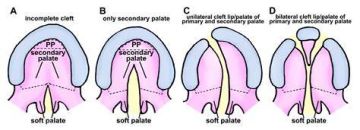 At what age is cleft palate repair?