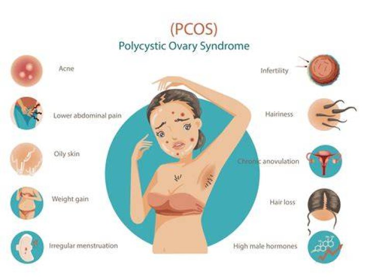 Can endocrinologists help with pcos?