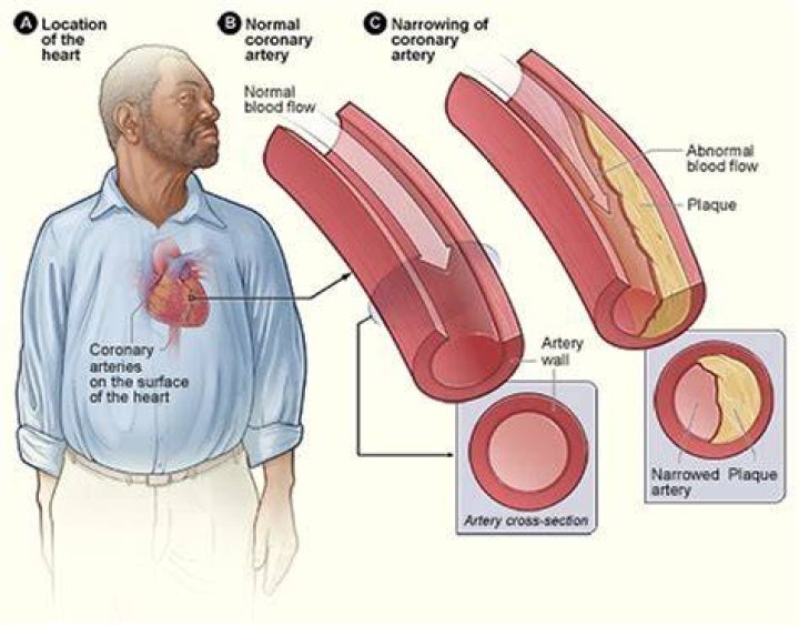 Can hardening of the arteries lead to heart attack?