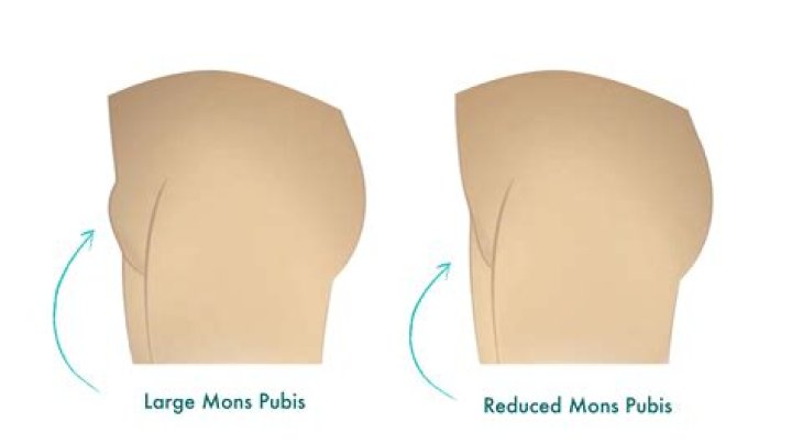 Can i make my mons pubis smaller?