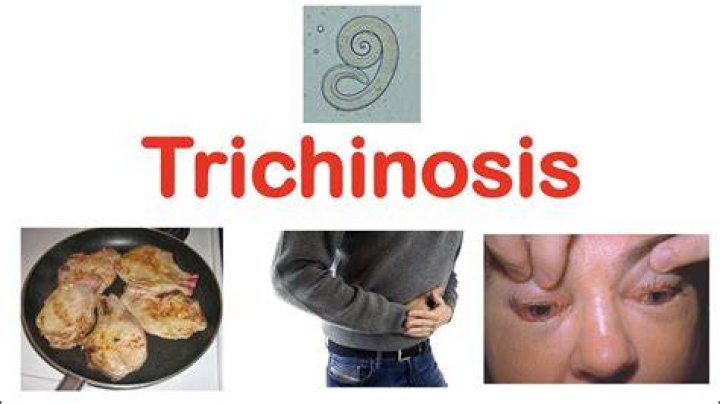Can trichinosis kill you?