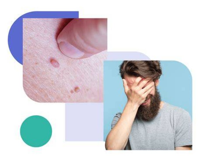 Do genital warts stay with you for life?
