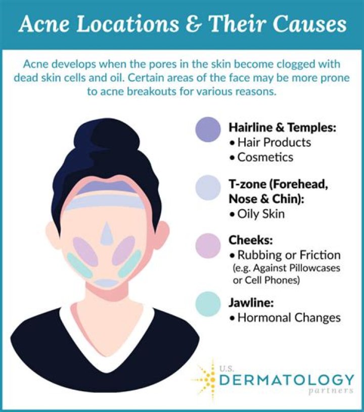 Do humectants cause acne?