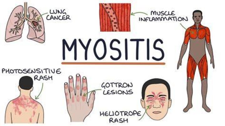 Do statins cause myositis?