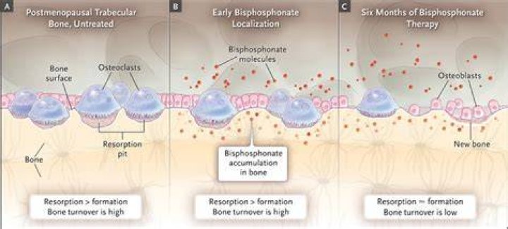 Does bisphosphonates cause osteonecrosis?