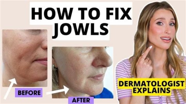 Does buccal fat removal help with jowls?