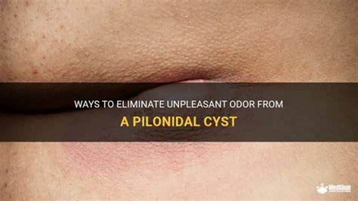 Has anyone had pilonidal?