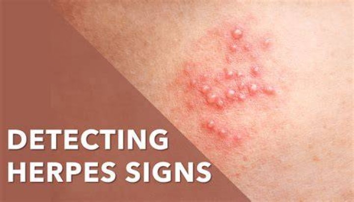 How herpes is treated?