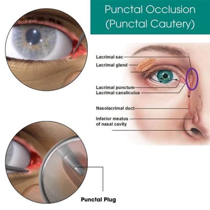 How to do punctal occlusion?