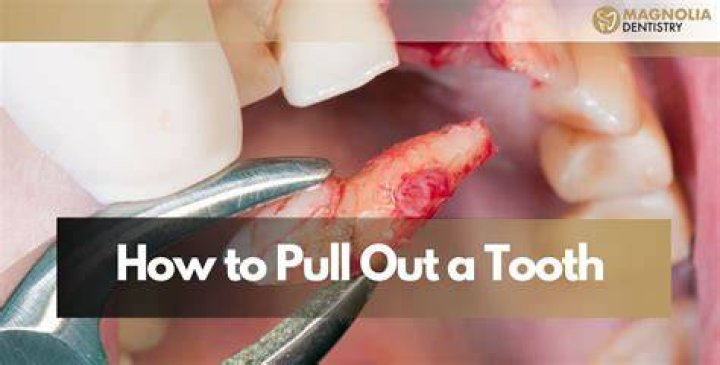 How to remove root of tooth?
