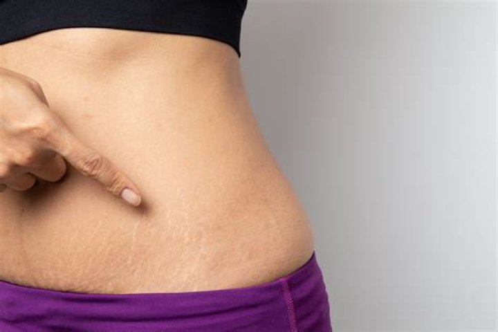 In pregnancy stretch marks?