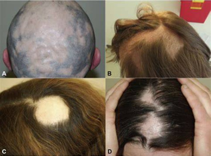 Is alopecia an autoimmune disease?