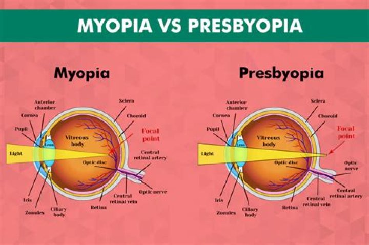 Is hyperopia and presbyopia the same?