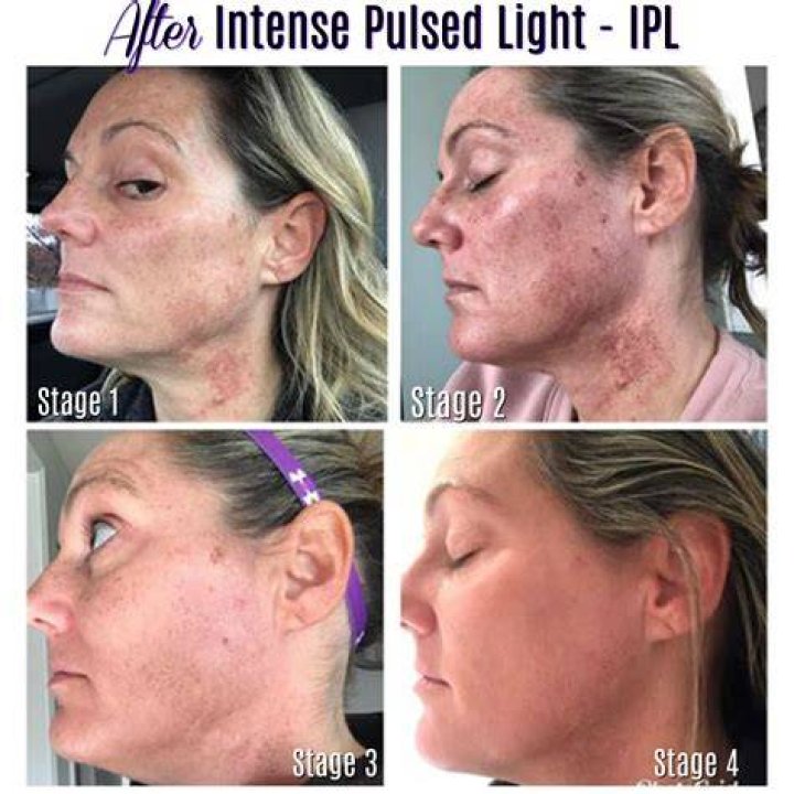 Is intense pulsed light a laser?