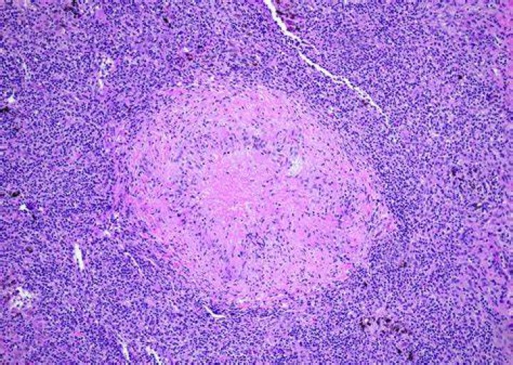 Is lymphogranuloma venereum curable?