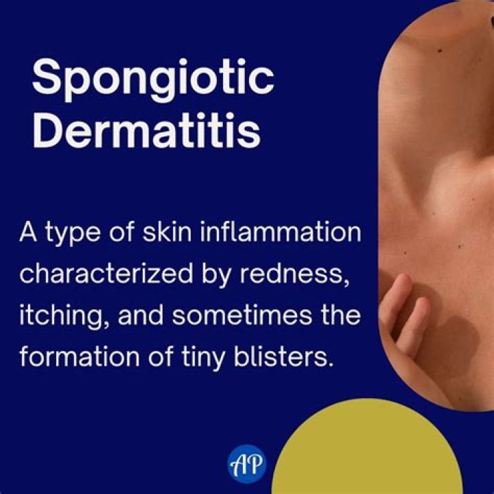 Is spongiotic dermatitis cancer?