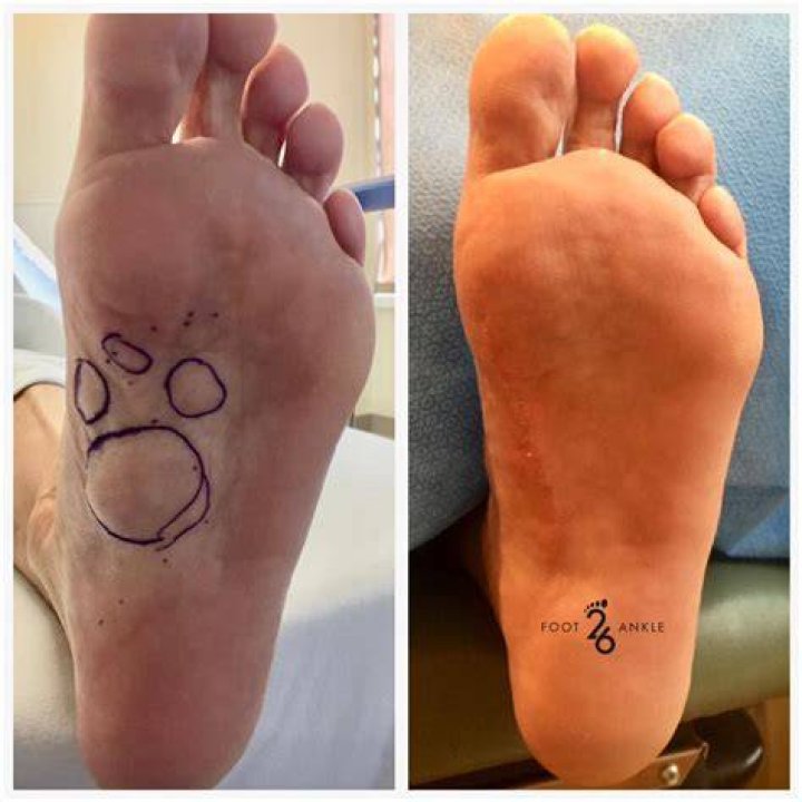 Should i get plantar fibroma surgery?