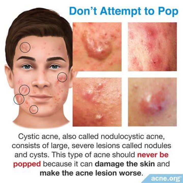 Should i pop acne?