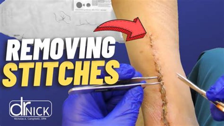 Should perineal stitches bleed?