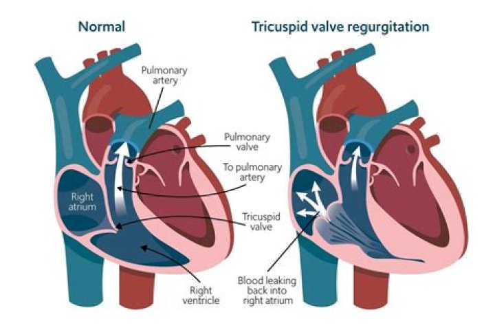 What's trivial tricuspid regurgitation?