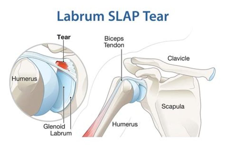 What is a slap tear in the shoulder?