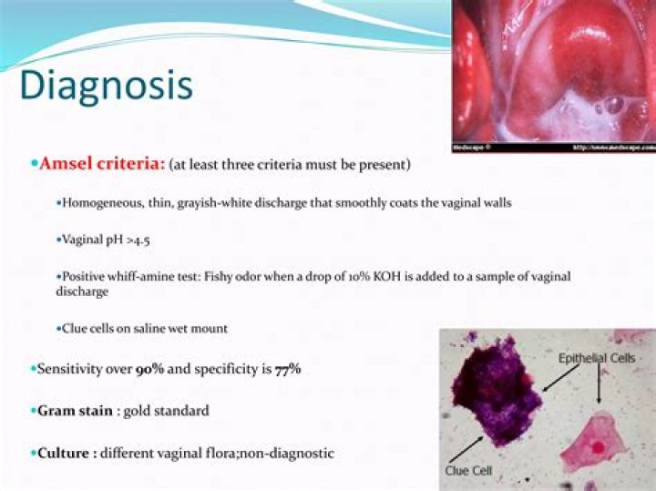 What is amsel criteria?