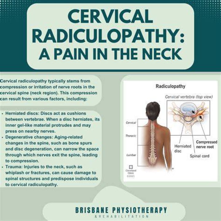 What is cervical spondylosis with radiculopathy?