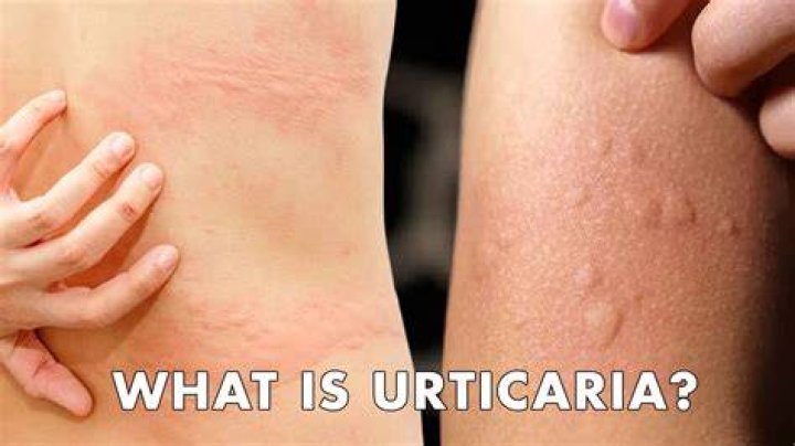 What is factitial urticaria?