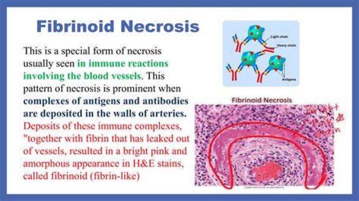 What is focal fibrinoid necrosis?