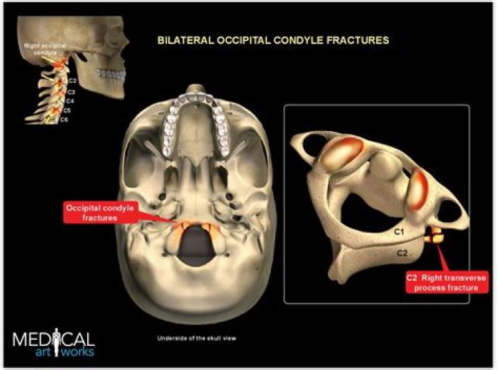 What is occipital condyle fracture?