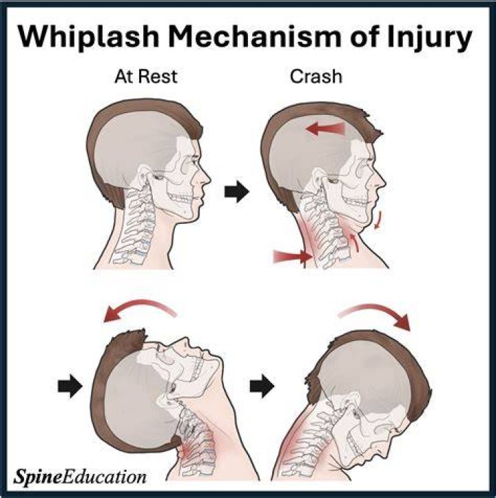What part of the brain is injured in whiplash?