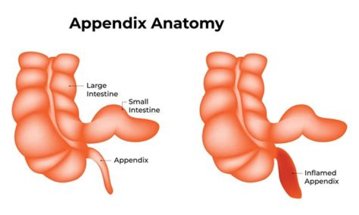 What side is appendix?