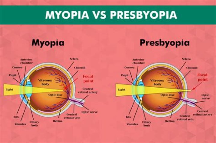 What type of lens corrects a presbyopic eye?