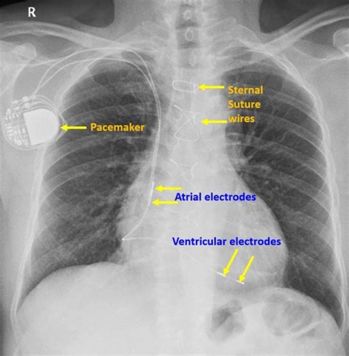Where are epicardial pacing wires placed?