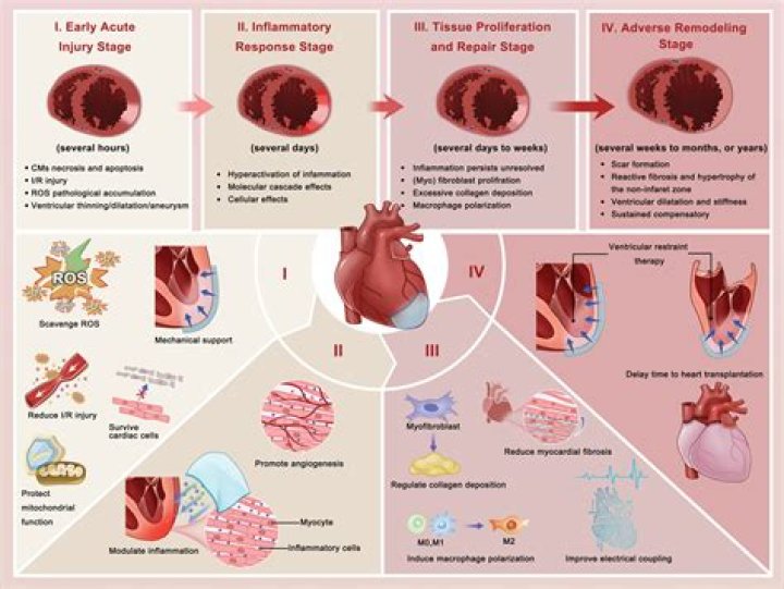 Where does myocardial hypertrophy occur?