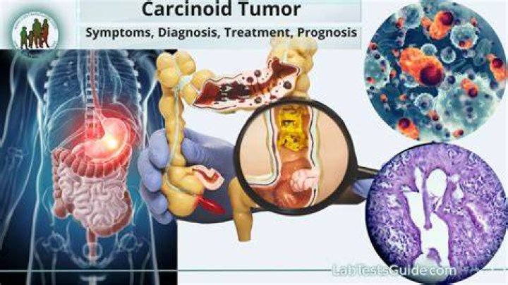 Where is your carcinoid?