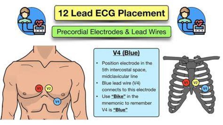 Which of the following is a precordial lead?