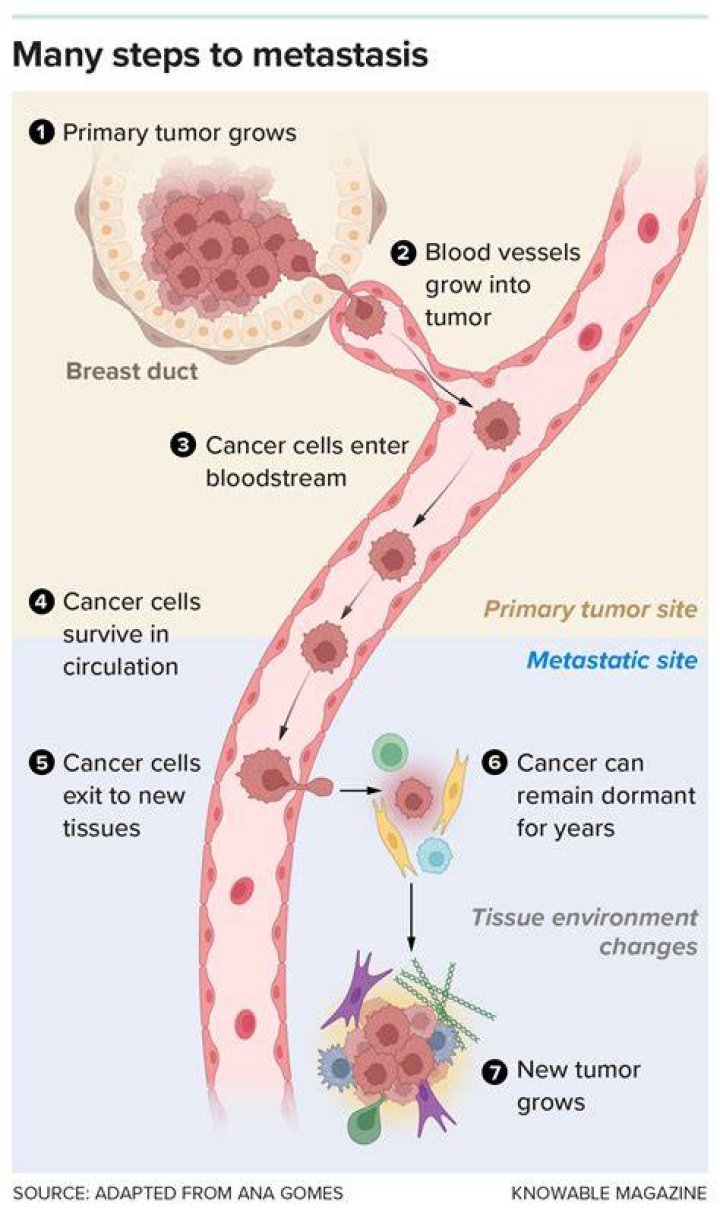 Who discovered cancer metastasis?