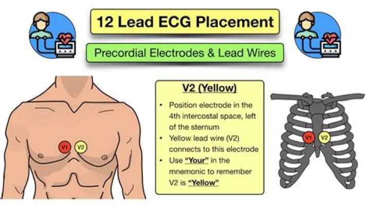 Why are precordial leads called v leads?