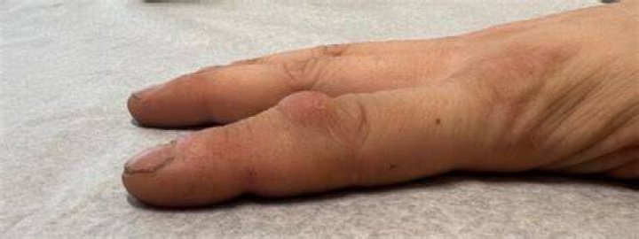 Why is my knuckle bone growing?