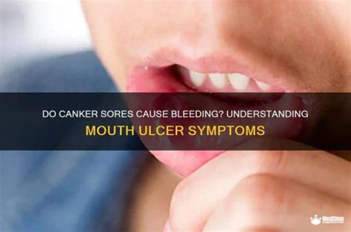 Will canker sores bleed?