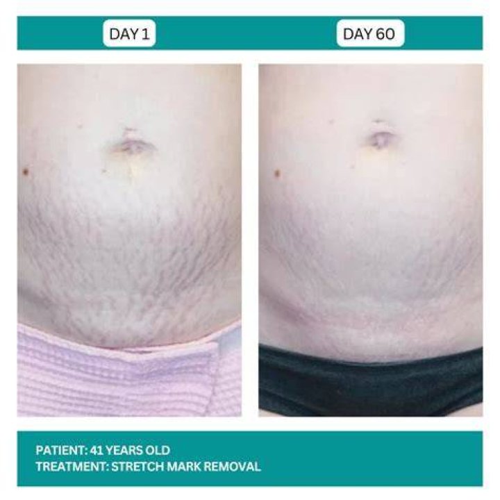 Will childhood stretch marks go away?