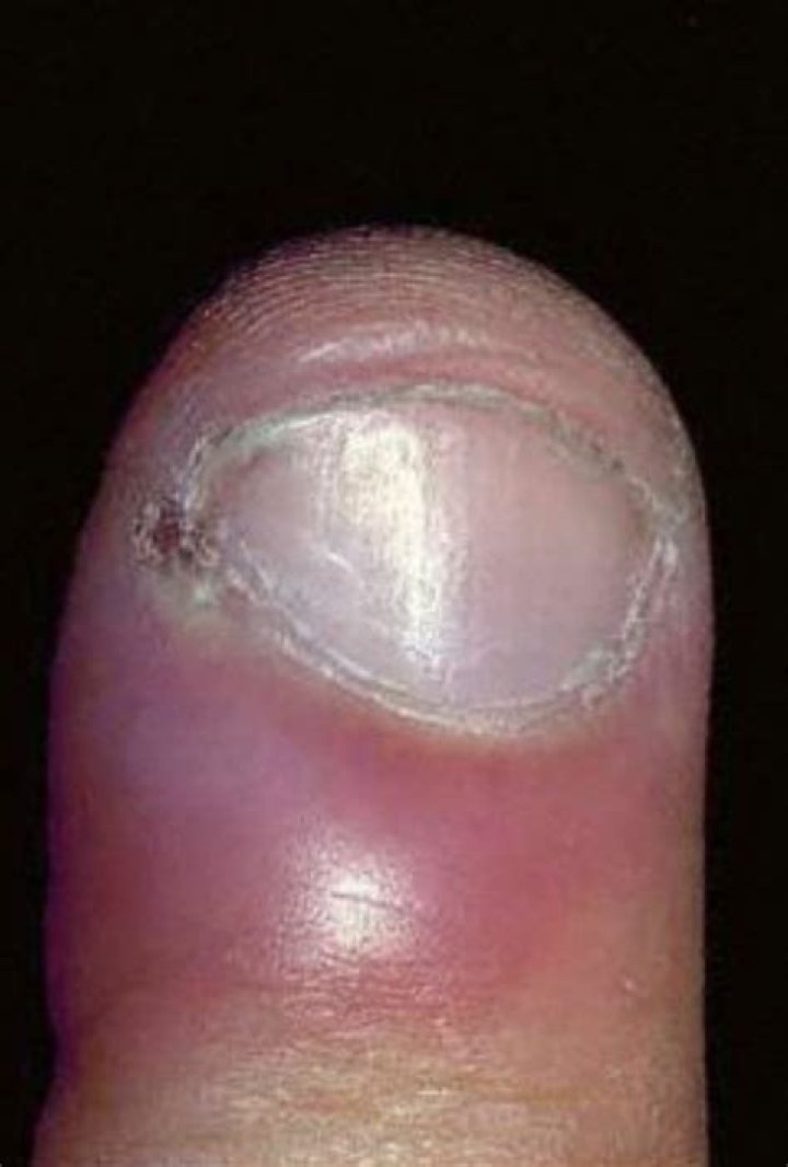 Will corsodyl cure infection?