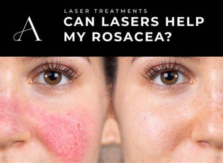 Will sunless tanner help rosacea?