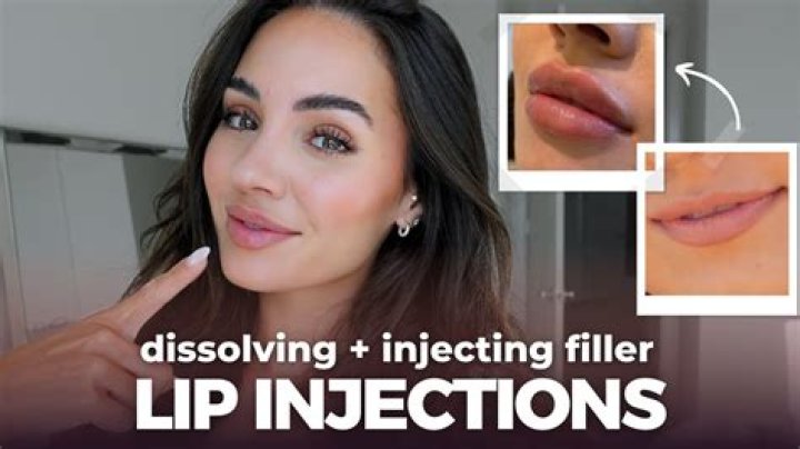 Would lip injections look good on me?